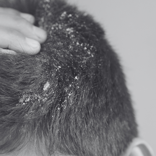 Dandruff